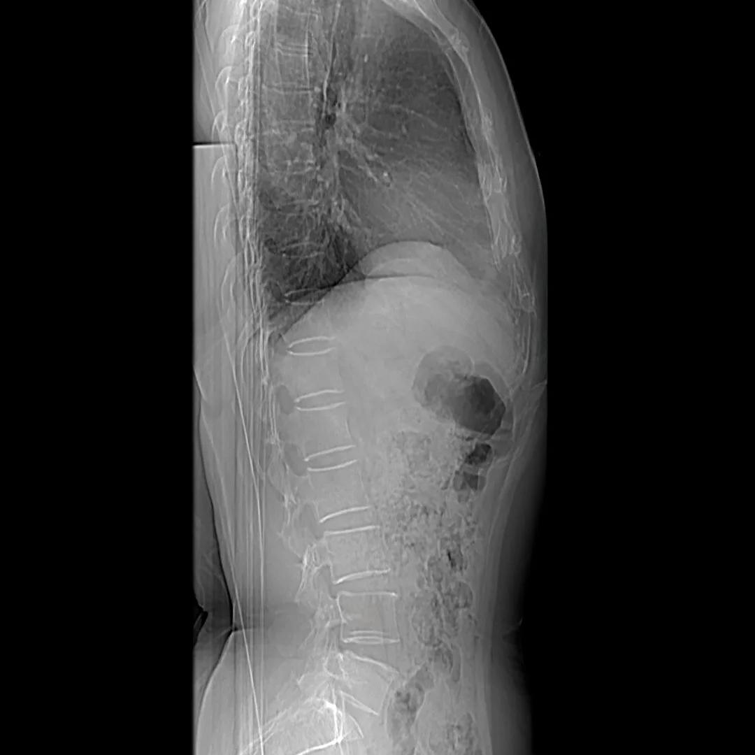 BMD SPINE X-RAY SCAN